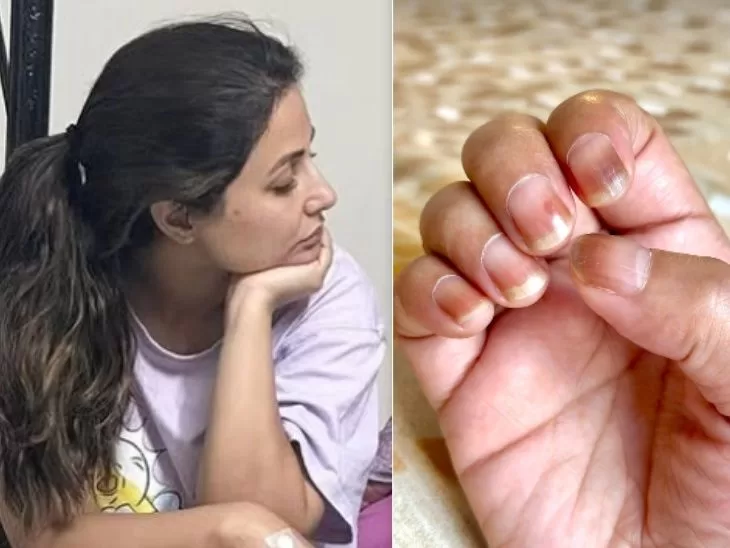 Hina Khan’s Nails Went on a Forced Vacation Thanks to Chemo | Actress Quips: “Sometimes They Just Quit and Fall Off, But Hey, It’s All Temporary!”